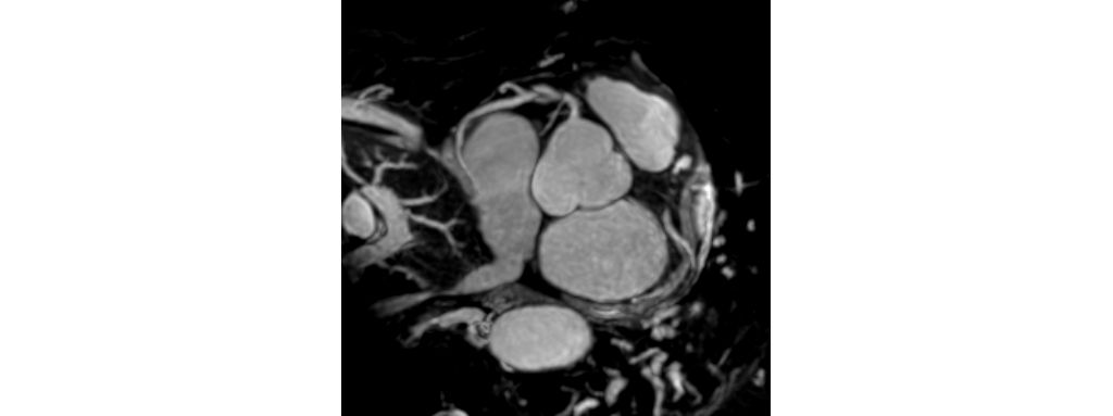 Coronary Acquisition