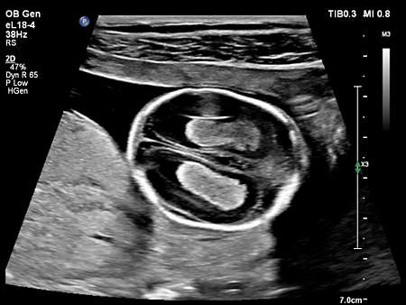 eL18-4 OB Imaging