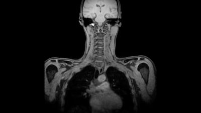 Philips - mDIXON XD FFE - HeadNeck MR clinical application - Philips