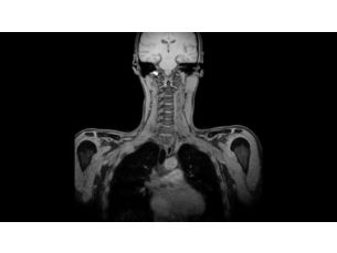 mDIXON XD FFE - HeadNeck MR clinical application