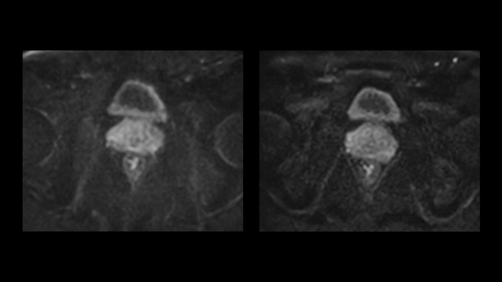 Conventional DWI versus IRIS DWI