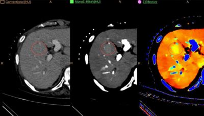 Philips IQon Spectral CT — Йодные карты и виртуальное нативное изображение