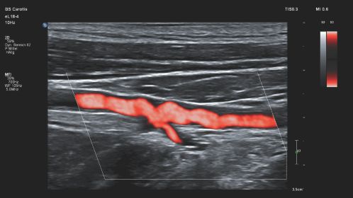 Affiniti CVx clinical image vascular