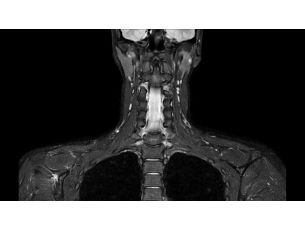 mDIXON XD TSE – HeadNeck MR clinical application