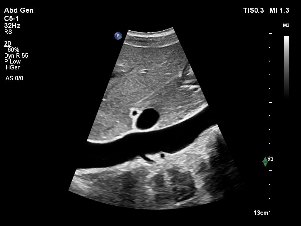 Liver and IVC in 2D using the C5-1 transducer