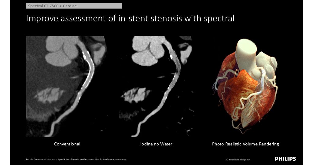 CT Spectral 7500 Cardiac - Improve assessment of in-stent stenosis with spectral
