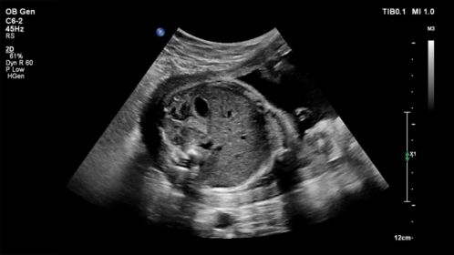 Fetal ultrasound image shown using C6-2 transducer