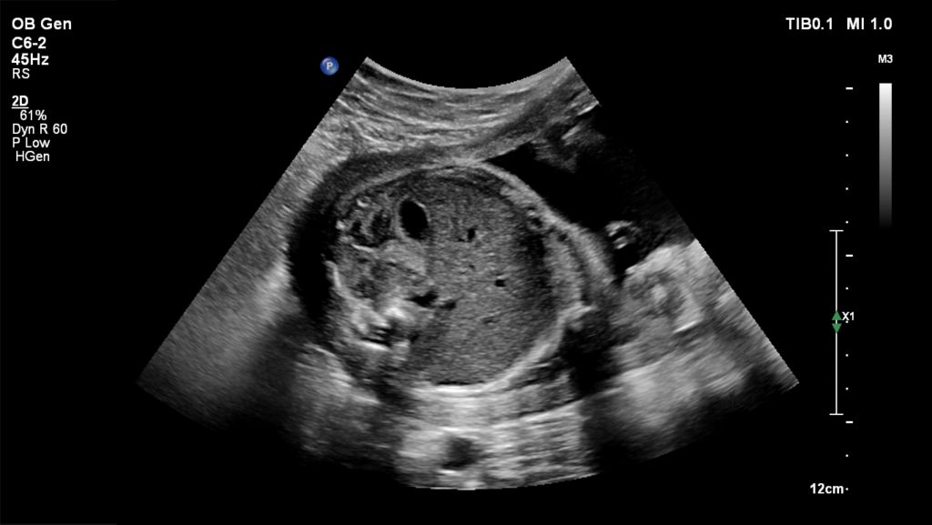 Fetal ultrasound image shown using C6-2 transducer