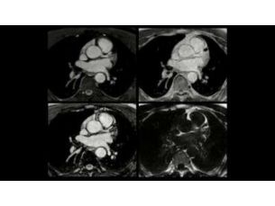 mDIXON XD FFE - Cardiac MR clinical application