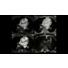 Philips mDIXON XD FFE MR clinical application thumbnail