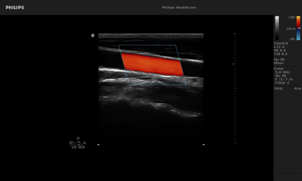 Cartoid image
