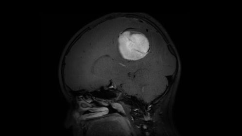 3D BrainVIEW Black Blood (9 year old)