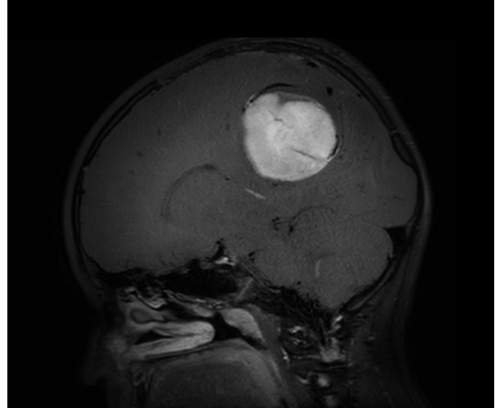 3D BrainVIEW Black Blood (9 year old)