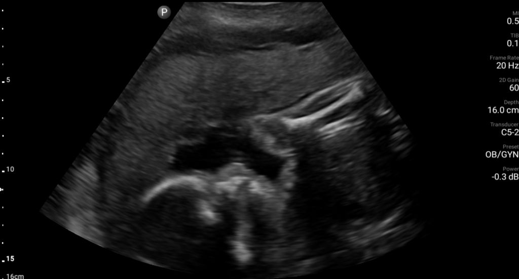 26 week OB fetal profile shown using C5-2 transducer.