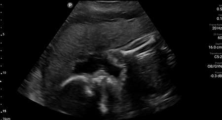 26 week OB fetal profile shown using C5-2 transducer.