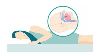 Illustration showing airway obstruction during supine sleep position
