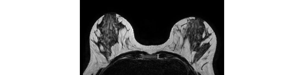 3D T2w VISTA - Breast