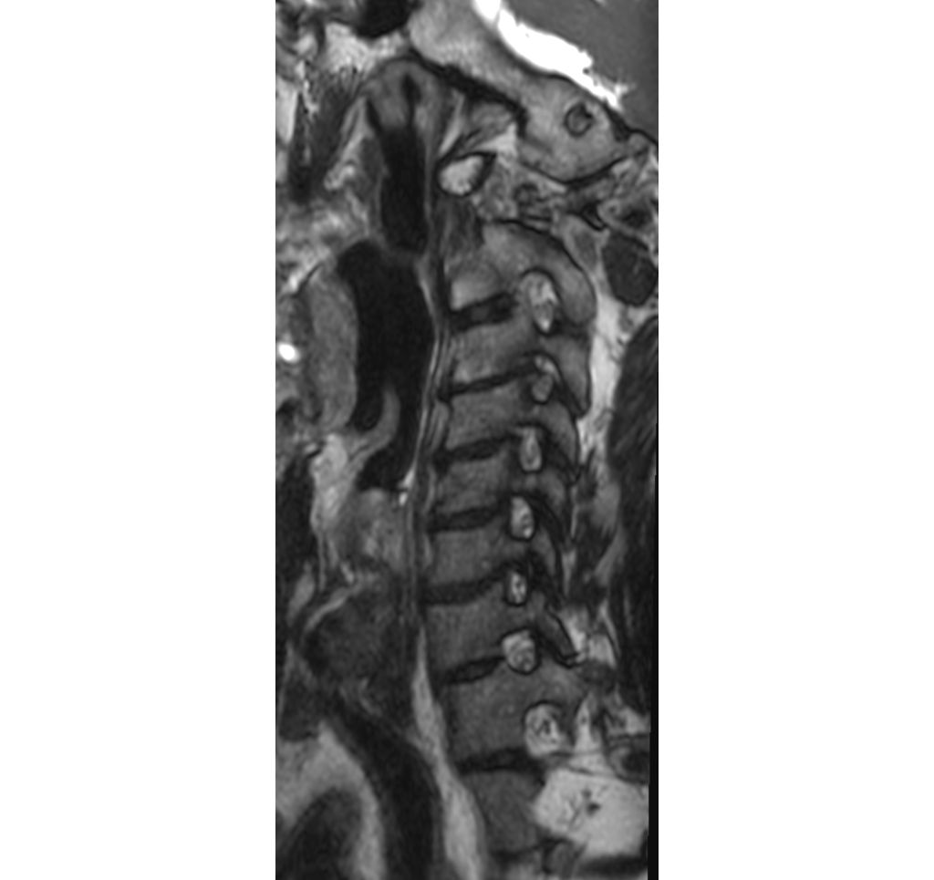 3D SpineVIEW T2w TSE - Oblique Reformat