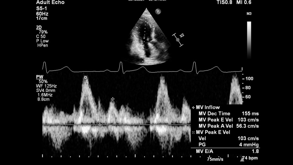 Auto Measure Doppler for mitral, tricuspid, aortic and pulmonary valves​ 