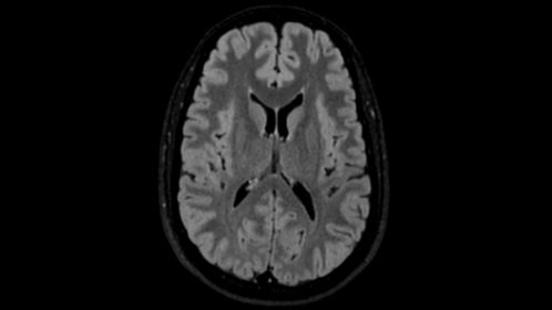 3D BrainView FLAIR