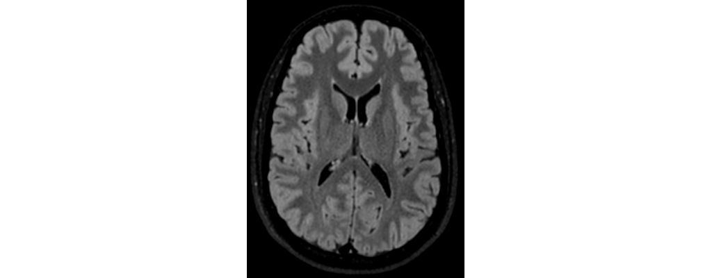 3D BrainView FLAIR