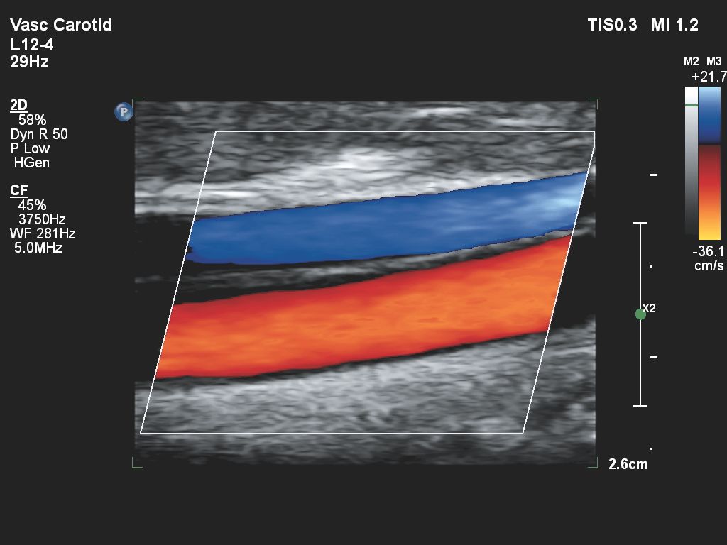 Affiniti 30 ultrasound clinical image vascular