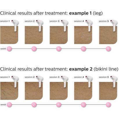 Philips Lumea Precision