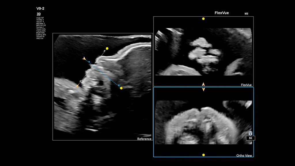 Fetal image using FlexVue and the V9-2 transducer
