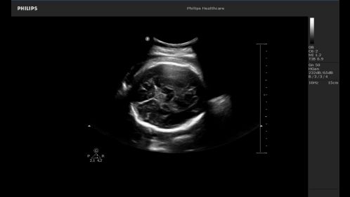 Fetal brain image