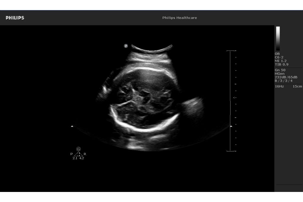 Fetal brain image