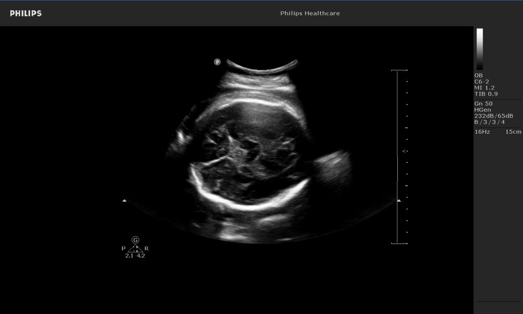Fetal brain image