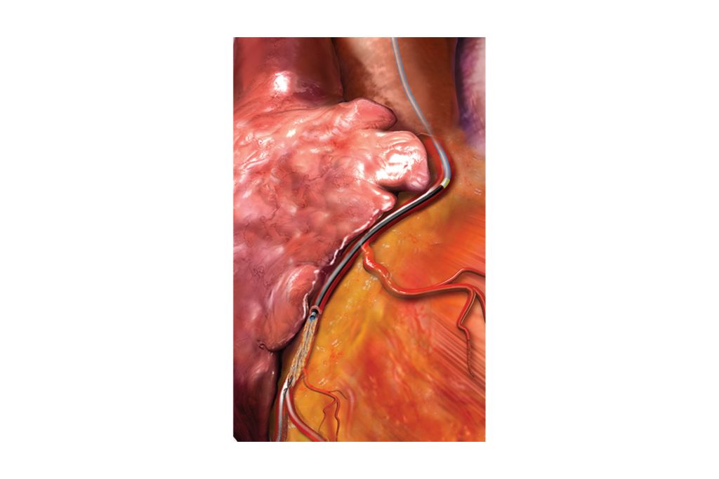Modifies plaque even behind stent struts