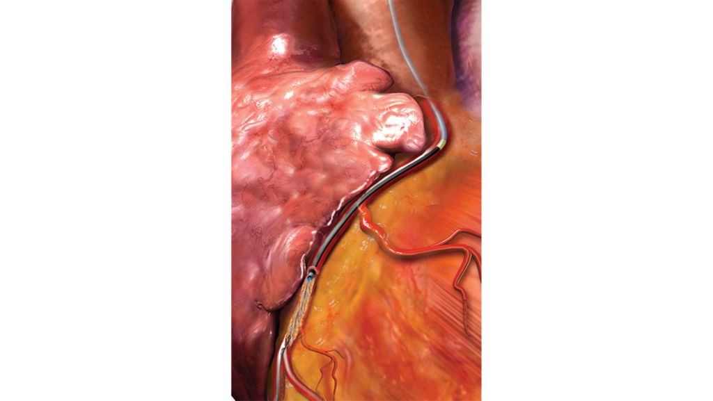 Modifies plaque even behind stent struts
