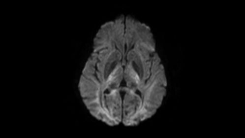 Axial Diffusion (b3000)