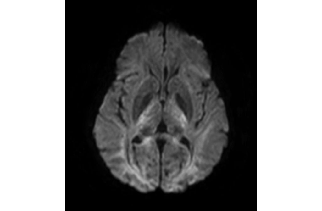 Axial Diffusion (b3000)