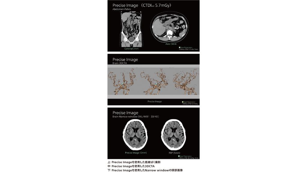 上：Precise Imageを使用した低被ばく撮影
中：Precise Imageを使用した3DCTA
下：Precise Imageを使用したNarrow windowの頭部画像