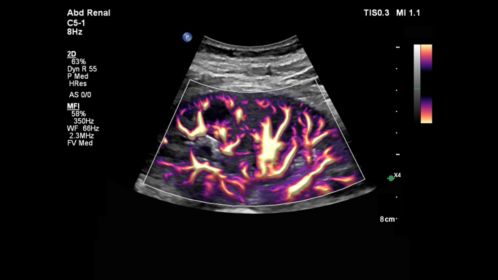 C5-1 Abdomen Renal Perfusion with MFI HD