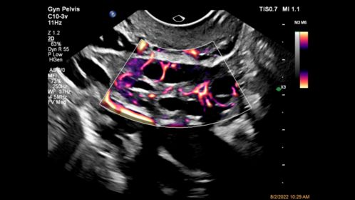 C10-3v Ovarian Perfusion with MFI HD