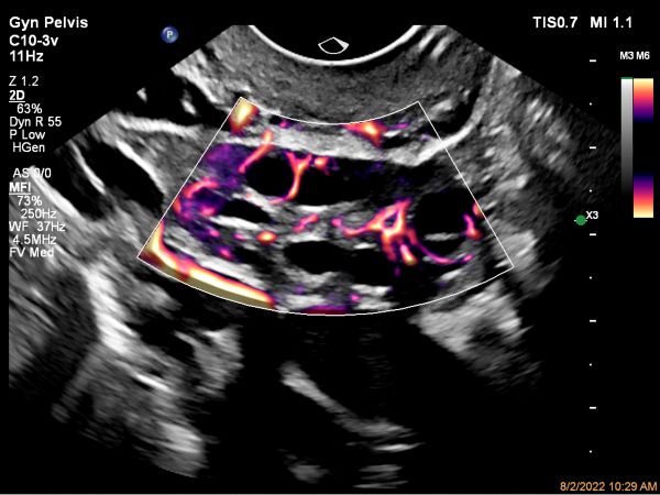 Ovarian blood flow with MFI