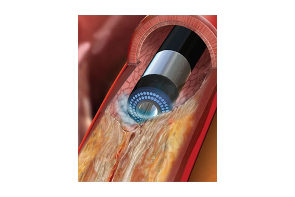 Adjustable laser energy settings to satisfy many clinical needs