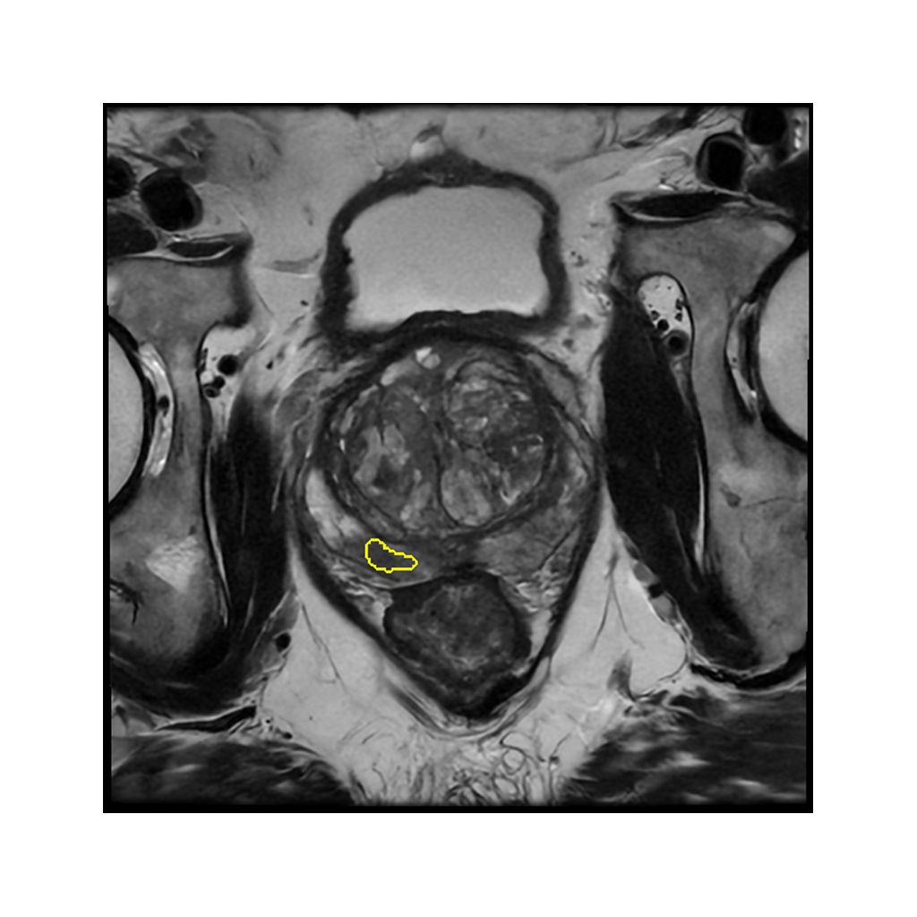 Lesion Segmentation DynaCAD 6