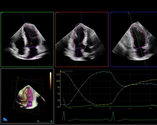 Echo Dynamic HeartModel screen capture software application