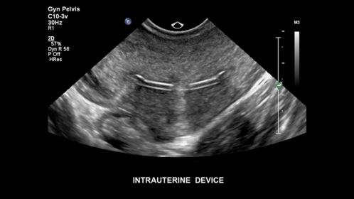 Intrauterine device