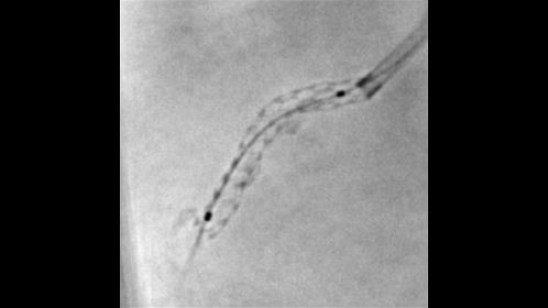 StentBoost image of a stent in the right coronary artery showing calcified plaque