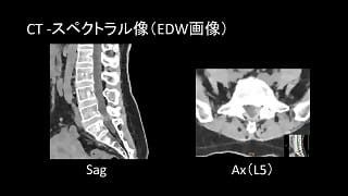 case 63
腰椎ヘルニア