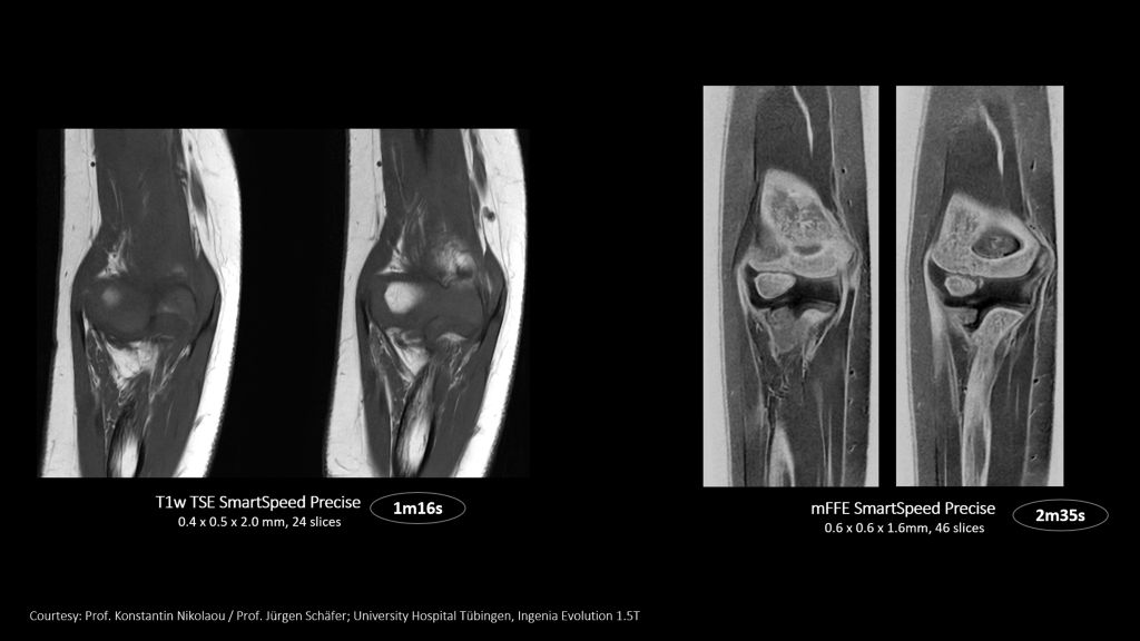 SmartSpeed Precise - Up to 3 times faster imaging. Preserve details in shorter scan times. Powered by Dual AI. 
Compared to Philips SENSE imaging. Dual AI: Reconstruction technology consisting of a first AI engine applied at the source of signal (Adaptive CS-NET) and a second AI engine applied on the raw complex imaging data (Precise Image Net).
