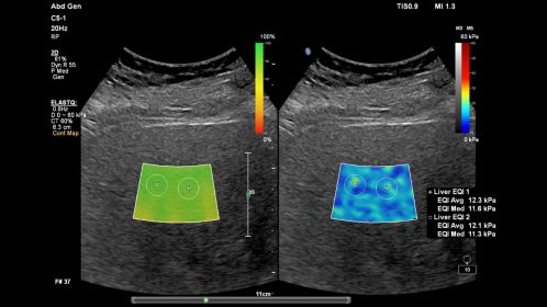 C5-1 Liver ElastQ with Confidence Map