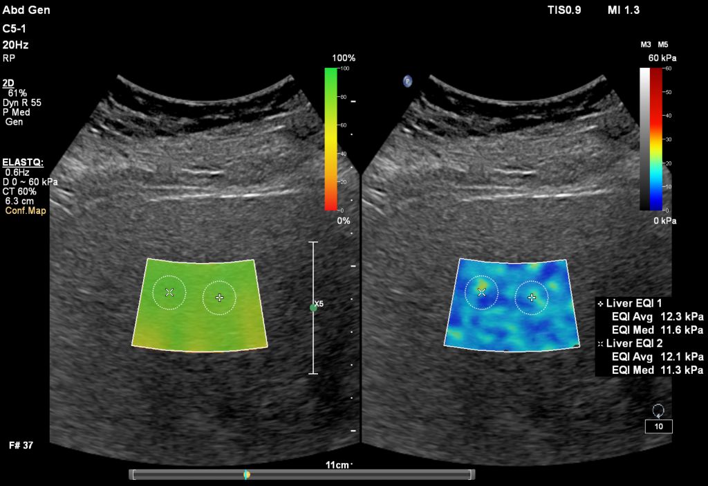 C5-1 Liver ElastQ