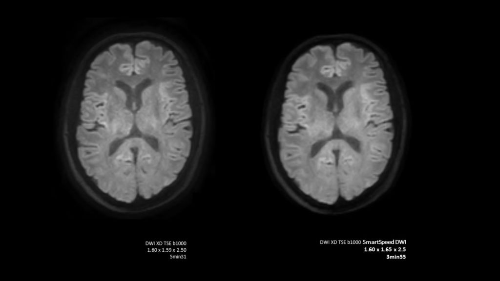 SmartSpeed Brain