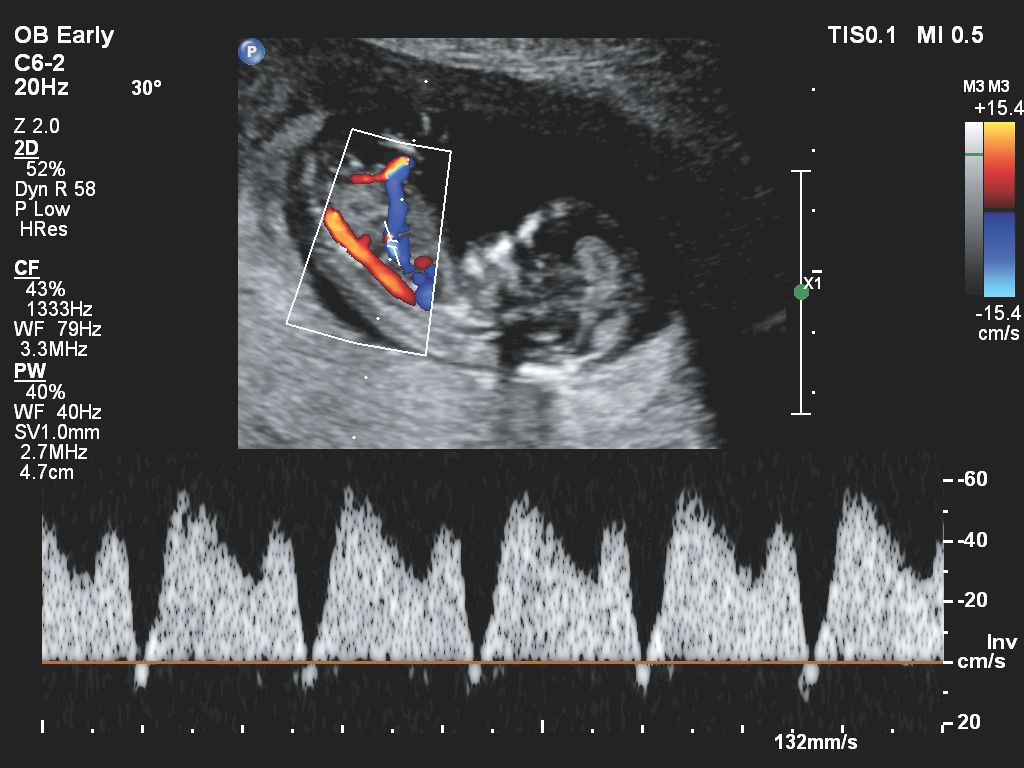 Affiniti 30 ultrasound clinical image obstetric